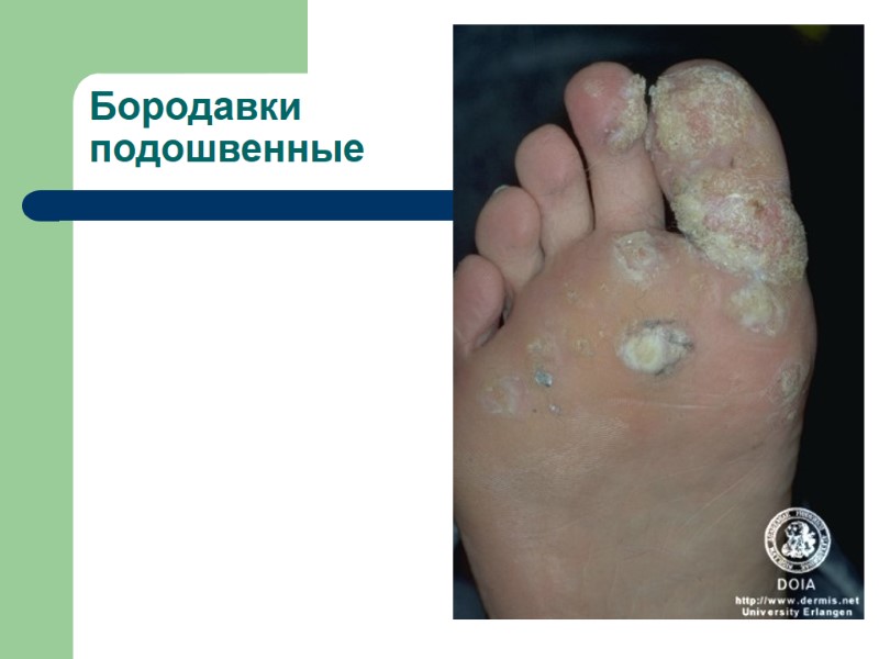 Бородавки подошвенные